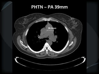 PHTN – PA 39mm
39.2mm
 