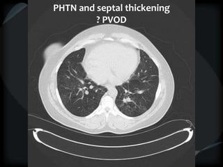 PHTN and septal thickening
? PVOD
 