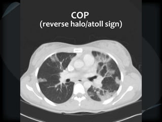 COP
(reverse halo/atoll sign)
 