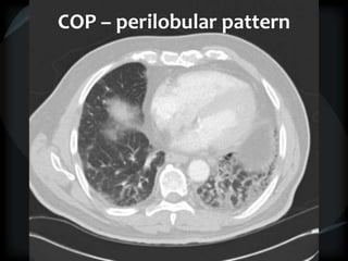 COP – perilobular pattern
 