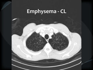 Emphysema - CL
 