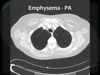 Emphysema - PA
 