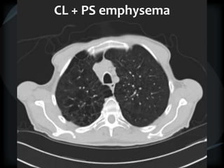 CL + PS emphysema
 