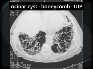 Acinar cyst - honeycomb - UIP
 