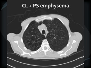 CL + PS emphysema
 