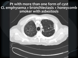 Pt with more than one form of cyst
CL emphysema + bronchiectasis + honeycomb
smoker with asbestosis
 