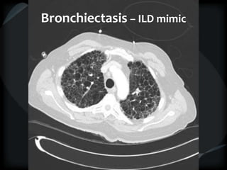 Bronchiectasis – ILD mimic
 