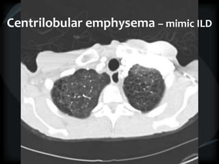Centrilobular emphysema – mimic ILD
 