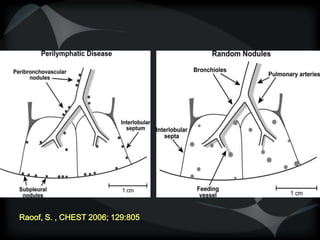 Raoof, S. , CHEST 2006; 129:805
 