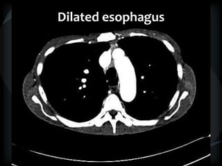 Dilated esophagus
 