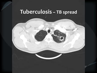 Tuberculosis – TB spread
 