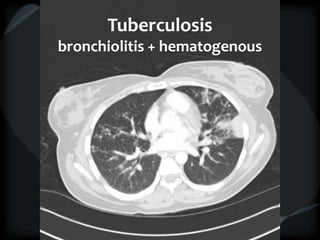 Tuberculosis
bronchiolitis + hematogenous
 