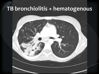 TB bronchiolitis + hematogenous
 