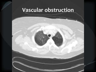Vascular obstruction
 