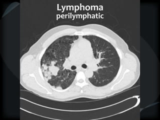 Lymphoma
perilymphatic
 