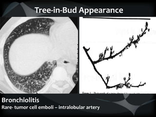 Tree-in-Bud Appearance
Bronchiolitis
Rare- tumor cell emboli – intralobular artery
 