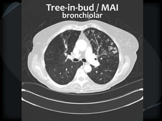 Tree-in-bud / MAI
bronchiolar
 