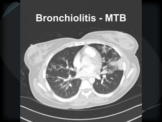 Bronchiolitis - MTB
 