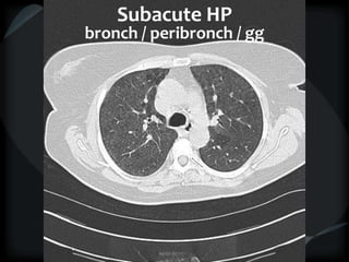 Subacute HP
bronch / peribronch / gg
 