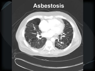 Asbestosis
 