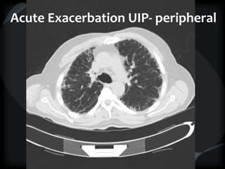 Acute Exacerbation UIP- peripheral
 