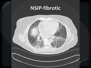 NSIP-fibrotic
 