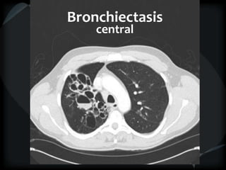 Bronchiectasis
central
 