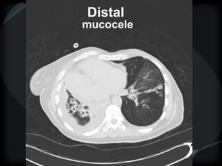 Distal
mucocele
 