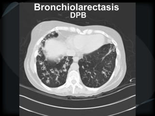 Bronchiolarectasis
DPB
 