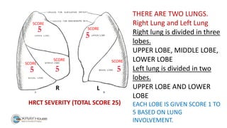HRCT SEVERITY (TOTAL SCORE 25)
THERE ARE TWO LUNGS.
Right Lung and Left Lung
Right lung is divided in three
lobes.
UPPER LOBE, MIDDLE LOBE,
LOWER LOBE
Left lung is divided in two
lobes.
UPPER LOBE AND LOWER
LOBE
EACH LOBE IS GIVEN SCORE 1 TO
5 BASED ON LUNG
INVOLVEMENT.
SCORE
SCORE
SCORE
SCORE
SCORE
R L
 