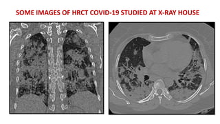 SOME IMAGES OF HRCT COVID-19 STUDIED AT X-RAY HOUSE
 