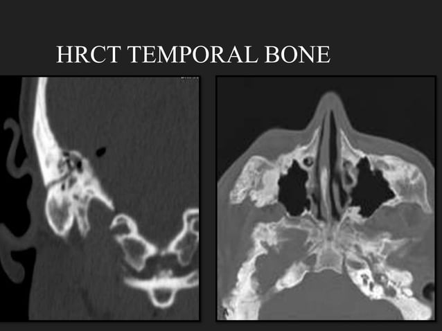 HRCT CHEST/TEMPORAL BONE PROTOCOL.pptx