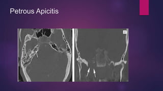 High Resolution Computer TomographyTEMPORAL BONE Pathology.pptx