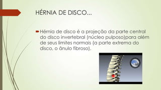 HÉRNIA DE DISCO...
Hérnia de disco é a projeção da parte central
do disco invertebral (núcleo pulposo)para além
de seus limites normais (a parte extrema do
disco, o ânulo fibroso).
 