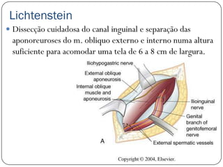 Lichtenstein
 Dissecção cuidadosa do canal inguinal e separação das
 aponoreuroses do m. obliquo externo e interno numa altura
 suficiente para acomodar uma tela de 6 a 8 cm de largura.
 