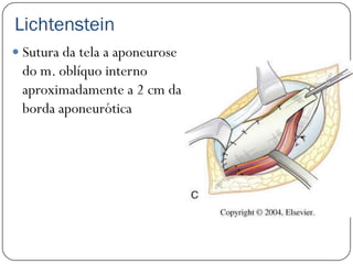 Lichtenstein
 Sutura da tela a aponeurose
 do m. oblíquo interno
 aproximadamente a 2 cm da
 borda aponeurótica
 