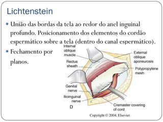 Lichtenstein
 União das bordas da tela ao redor do anel inguinal
  profundo. Posicionamento dos elementos do cordão
  espermático sobre a tela (dentro do canal espermático).
 Fechamento por
  planos.
 