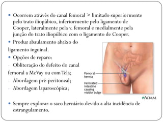  Ocorrem através do canal femoral > limitado superiormente
   pelo trato iliopúbico, inferiormente pelo ligamento de
   Cooper, lateralmente pela v. femoral e medialmente pela
   junção do trato iliopúbico com o ligamento de Cooper.
 Produz abaulamento abaixo do
ligamento inguinal.
 Opções de reparo:
- Obliteração do defeito do canal
femoral a McVay ou com Tela;
- Abordagem pré-peritoneal;
- Abordagem laparoscópica;


 Sempre explorar o saco herniário devido a alta incidência de
  estrangulamento.
 