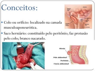 Conceitos:
 Colo ou orifício: localizado na camada
  musculoaponeurótica.
 Saco herniário: constituído pelo peritônio; faz protusão
  pelo colo; branco nacarado.
 