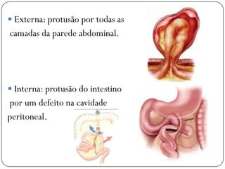  Externa: protusão por todas as
camadas da parede abdominal.




 Interna: protusão do intestino
por um defeito na cavidade
peritoneal.
 