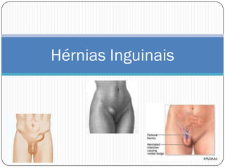 Hérnias Inguinais
 