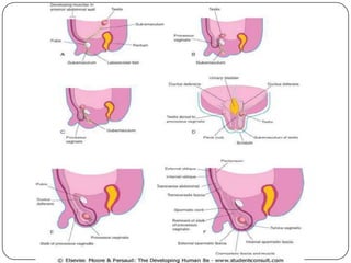  Tanto as hérnias inguinais indiretas quanto as
  femorais ocorrem mais comumente no lado
  direito.
- Inguinal : > demora na atrofia do processo
  vaginal pela descida mais lenta do testículo
  direito).
- Femoral efeito tamponante do sigmóide a
  esquerda.
 