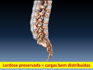 Lordose preservada = cargas bem distribuídas
 