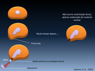 200%
Muito tempo depois....
Não ocorre cicatrização discal,
apenas reabsorção do material
nuclear
Protrusão
Hénia extrusa ou prolapso discal
Sequestro
(Adams et al., 2002)
 