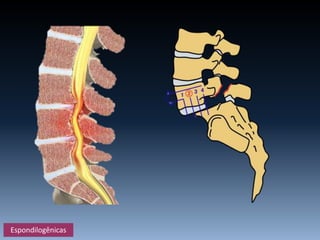 Espondilogênicas
 