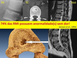 RX TC RMI
74% das RMI possuem anormalidade(s) sem dor!
(Jensen et al., 1994)
 