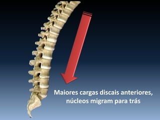 Maiores cargas discais anteriores,
núcleos migram para trás
 