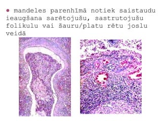 ● mandeles parenhīmā notiek saistaudu
ieaugšana sarētojušu, sastrutojušu
folikulu vai šauru/platu rētu joslu
veidā
 