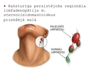 ● Raksturīga persistējoša reģionāla
limfadenopātija m.
sternocleidomastoideus
priekšējā malā
 