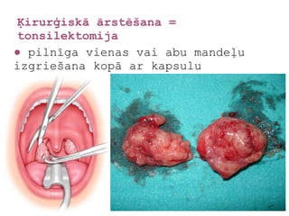 Ķirurģiskā ārstēšana =
tonsilektomija
● pilnīga vienas vai abu mandeļu
izgriešana kopā ar kapsulu
 